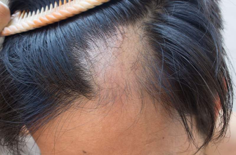 Caduta dei capelli, stress e possibili rimedi: tutto quello che c’è da sapere